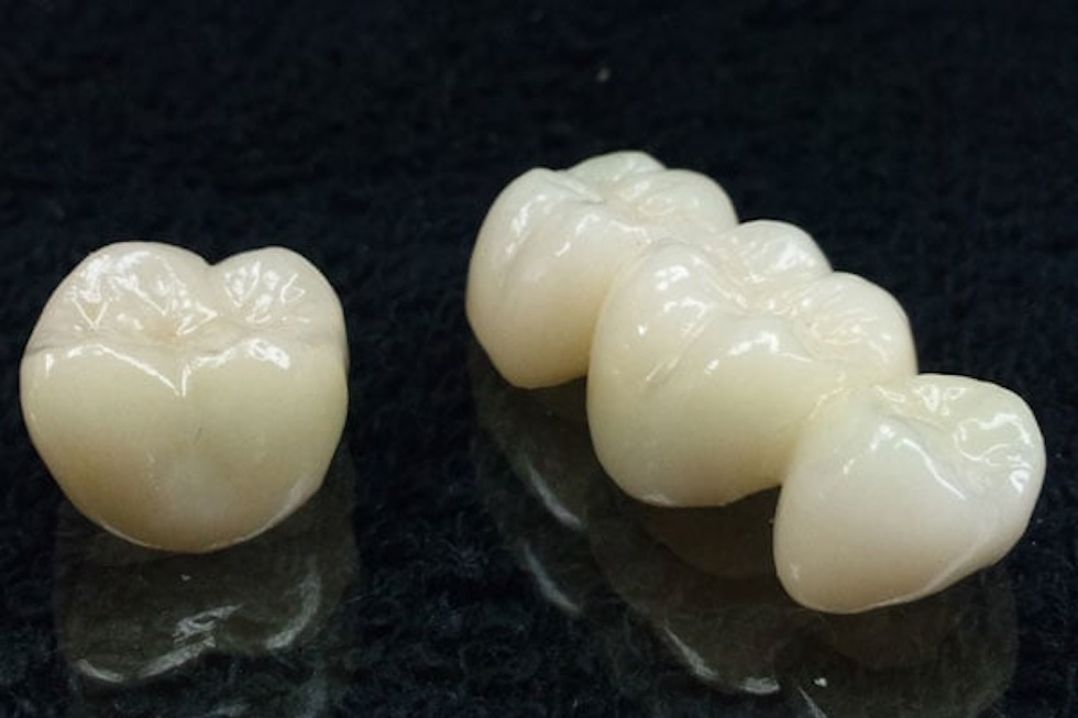 ジルコニアクラウン/ジルコニアインレー